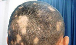 Alopecia areata la femei: tratament Dieta pentru alopecia areata